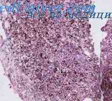 Ganglioneuroma i ganglionevroblastoma djece. Pheochromocytoma i teratom u djece