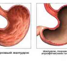 Gastritisa i raka želuca