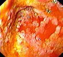 Gastritis s intestinalne metaplazije