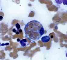 Hemophagocytic lymphohistiocytosis: liječenje, uzroci prognozu