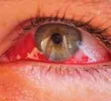 Hemophthalmus oči liječenje, uzroci, klasifikacija, simptomi