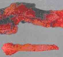 Hemoragijski pankreatitis nekrotizirajući i akutni oblik