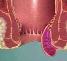 Hemeroida tromboza: faza, simptomi i tretmani