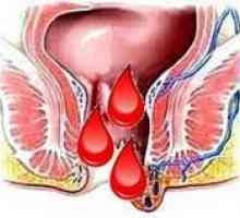 Hemoroidi tijekom menstruacije, zašto je pogoršan ispred njih?