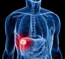Hepatocelularni karcinom jetre: simptoma, liječenje, prognoza, dijagnoza