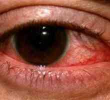 Hcrpctički keratitis očiju: liječenje, prevencija, simptomi, uzroci