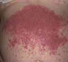 Dermatitis herpetiformis: simptoma, liječenje