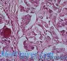 Hyperparathyroid generalizirani fibrozni osteodistrofiju (von Recklinghausen bolest) morfologiju,…