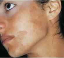 Hiperpigmentaciju kože: liječenje, uzroci, prevencija
