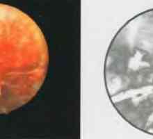 Histeroskopija kao metoda za vizualnom procjenom površinu rane maternice nakon poroda