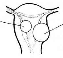 Histeroskopija u dijagnostici i liječenju mioma maternice