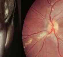 Očni toxocariasis, simptomi i tretman kod odraslih