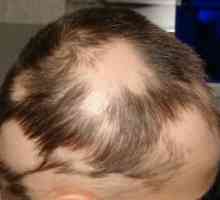 Alopecija areata Liječenje, uzroci, simptomi