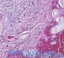 Gormonalnoaktivnye tumori testisa leydigomy