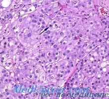 Gormonalnoaktivnye tumor nadbubrežne žlijezde