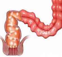 Granulomatozni kolitis i enteritis