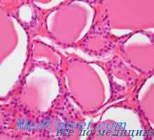Granulomatozni tireoiditis de Quervain je morfologija, patološka anatomija