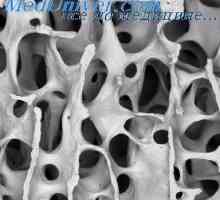 Chondromatosis kosti Ollier bolesti. Osteochondral exostoses novorođenčad