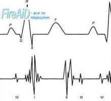 Srce zvuči. Prvi (sistolički) srce zvuk. Drugi (dijastolički) srce zvuk. Phonocardiogram.