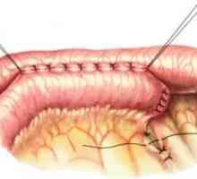 Promjena anatomiju probavnog trakta, kao rezultat operacije. anastomoze