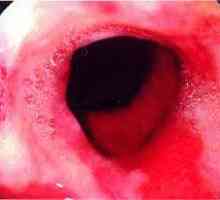 Ulceroznog ezofagitisa jednjaka