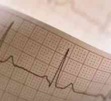 Električni Nestabilnost infarkt: liječenje, uzroci, simptomi, znakovi