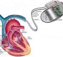 Implantirati i elektrostimulator