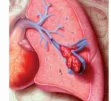 Plućna embolija: Simptomi, liječenje