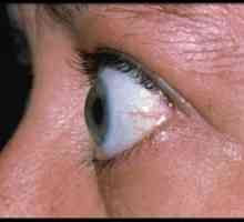 Endokrini oftalmopatija: liječenje, simptomi, dijagnoza, klasifikacija