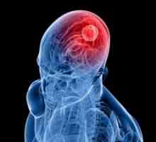 Epiduralni hematom na mozgu: simptomi, liječenje, posljedice