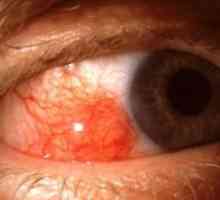 Episcleritis očiju: liječenje, simptomi, uzroci