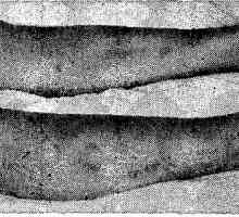 Eritema nodosum. klinička slika