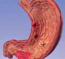 Etiologija kronični gastritis