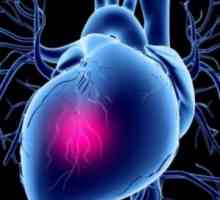 Kardiogeni šok: liječenje, simptomi, uzroci, simptomi
