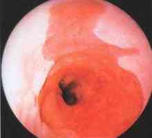 Kataralni (površina) ezofagitis niži trećinu jednjaka