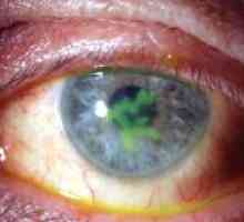 Keratitis očiju: liječenje, simptomi, uzroci, simptomi