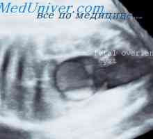 Ciste i tumora fetalnih jajnici. Gidrometrokolpos i hydrocele u fetus
