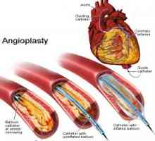 Koronarna angioplastika