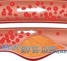 Kožne krvne žile u diabetes mellitus. Mikroangopatije u dijabetes