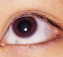 Granica keratitis očiju: liječenje, uzroci, simptomi