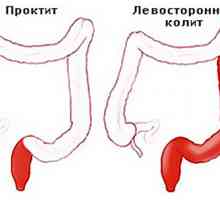 Lijevo jednostrana kolitis, crijeva