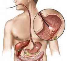 Limfom želuca i crijeva: tretman Pronoza, znakovi, simptomi, uzroci