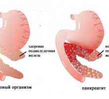 Pankreatitisa induciran lijekovima