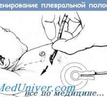 Metode pražnjenja pleuralni šupljine novorođenče iza