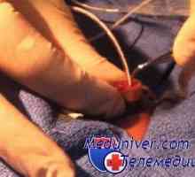 Metode Prikupljanje krvi od pupčane katetera arterije