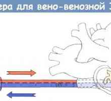 Postupak veno-venskog kateterizacije radi vantjelesnom membrane oksigenacije (ECMO)
