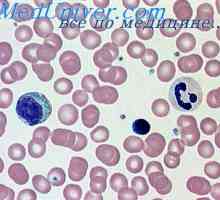 Uništavanje hemoglobina. razne anemije