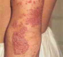 Miniatlas: kožne bolesti uz svrbeža