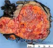 Morfologija nadbubrežne tumora. Androsteromy