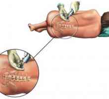 Anestezija i epiduralna anestezija tijekom operacije ukloniti hemoroide